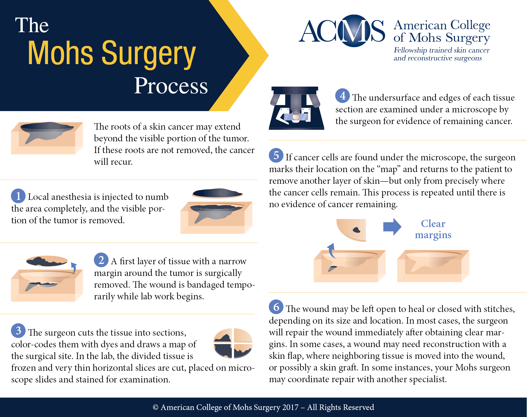 acms mohs surgery process infographic square
