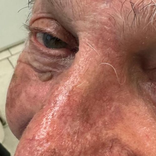 patient 1 04 3 months f u