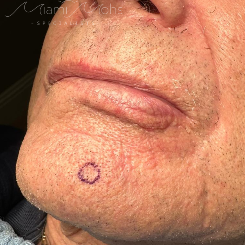 patient 2 01 before mohs