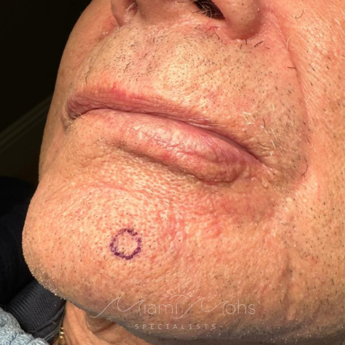 patient 2 01 before mohs