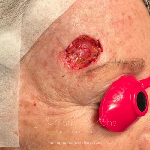 patient 3 02 post mohs (2)