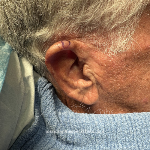 Before Mohs surgery on the right ear