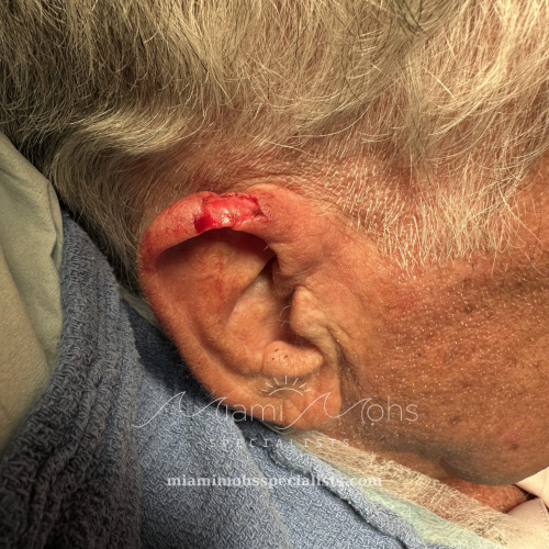Right ear wound after Mohs surgery