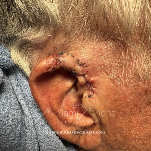 Right ear immediately after reconstruction