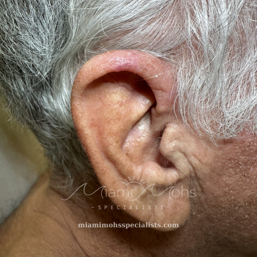 Right ear at four-month follow-up