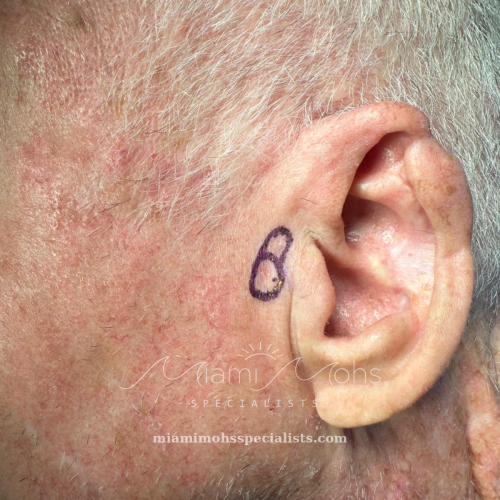 Left preauricular area before Mohs surgery