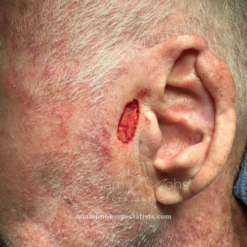 Left preauricular wound after Mohs surgery