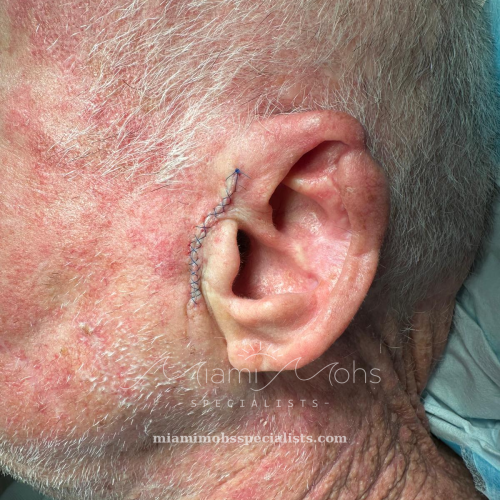 Left preauricular area immediately after reconstruction
