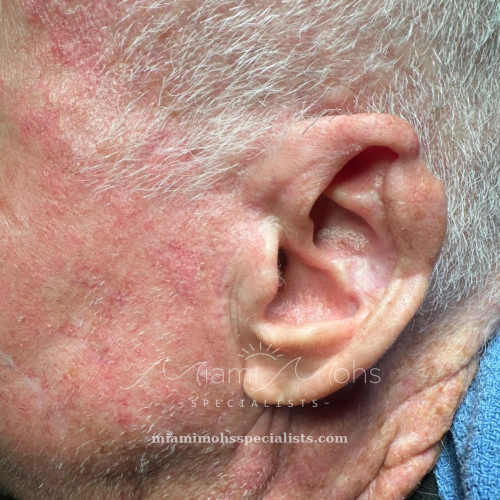 Left preauricular area at two-month follow-up